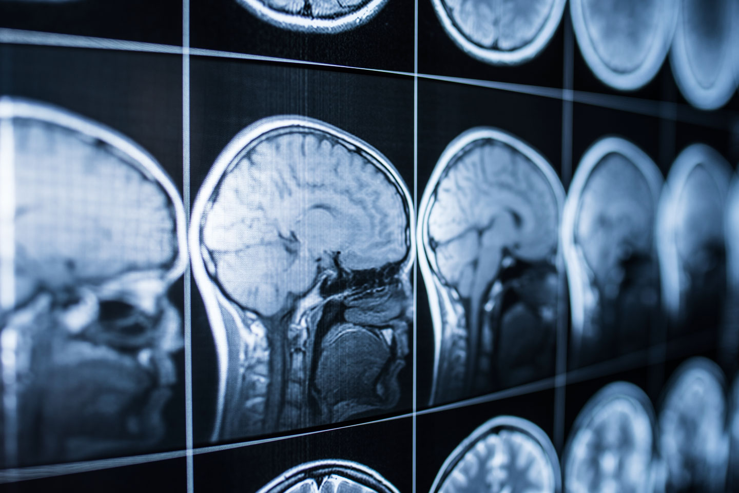 Brain Injury