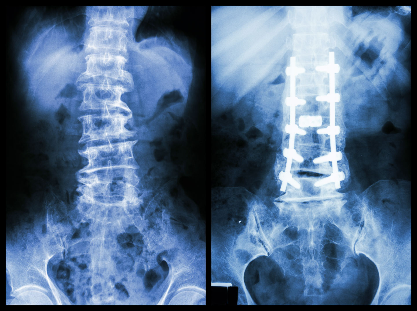 Spinal Injury